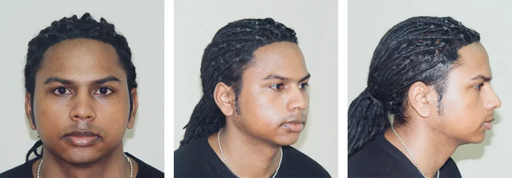 Facial-chin-implant-surgery-by-doctor-Chettawut-before