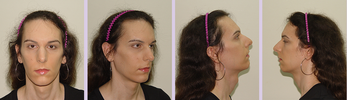 Facial-feminization-for-forehead-and-nose-(Dr.Chettawut-FFS-before-surgery)