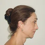 Forehead contouring surgery + Eyebrow lift +Scalp advancement surgery + Lip augmentation + Feminizing Rhinoplasty + Alarplasty + Jaw & Chin contouring +Face and neck lift surgery + Trachea shave surgery
