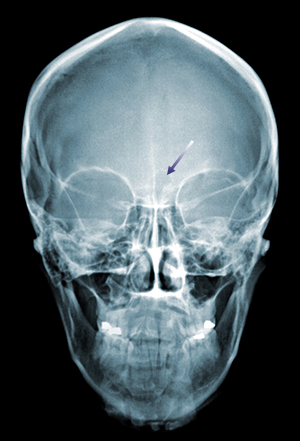 Forehead-type-2-skull-x-ray-AP-view