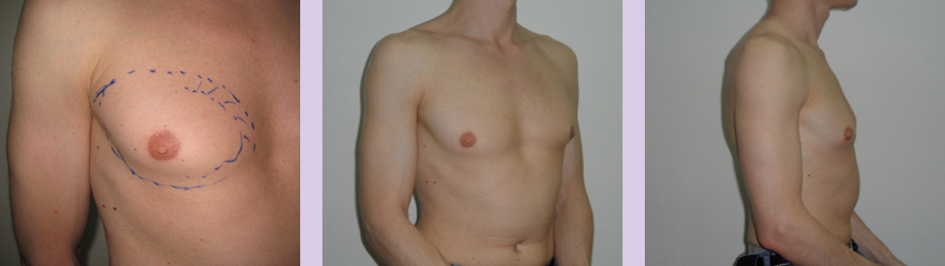Gynecomastia-surgery-doctor-Chettawut-Gallery--before-total-breast-removal-surgery