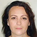 Case 3 Lip lift + Permanent Lip Augmentation