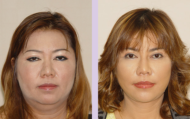 Liposuction-face-and-neck-with-face-and-neck-lift-surgery-case-1-doctor-Chettawut-facial-contouring-surgery-gallery