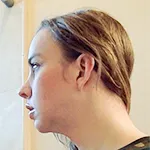 Case 1 Reduction rhinoplasty