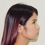 Case 3 Augmentation Rhinoplasty + Alarplasty