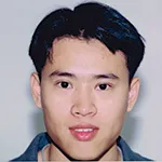 Case 4 Upper eyelid - Double eyelid surgery