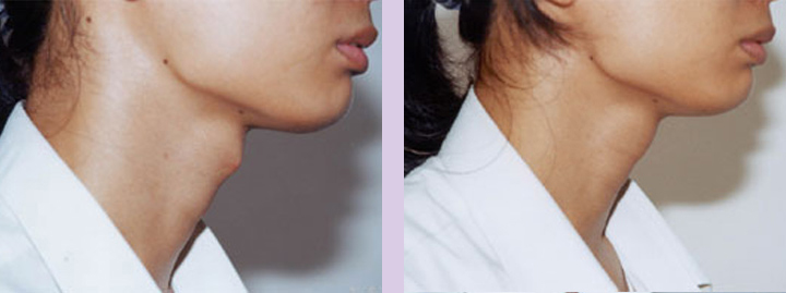 Trachea-Shave-Surgery-before-and-after-case-1-by-Dr.Chettawut-Bangkok-Thailand