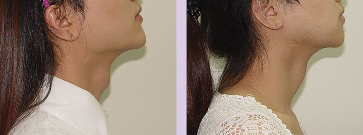Trachea-Shave-Surgery-before-and-after-case-3-by-doctor-Chettawut-Baangkok-Thailand